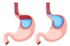 علاج ارتجاع المريء